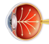 glaucoma treatment varanasi