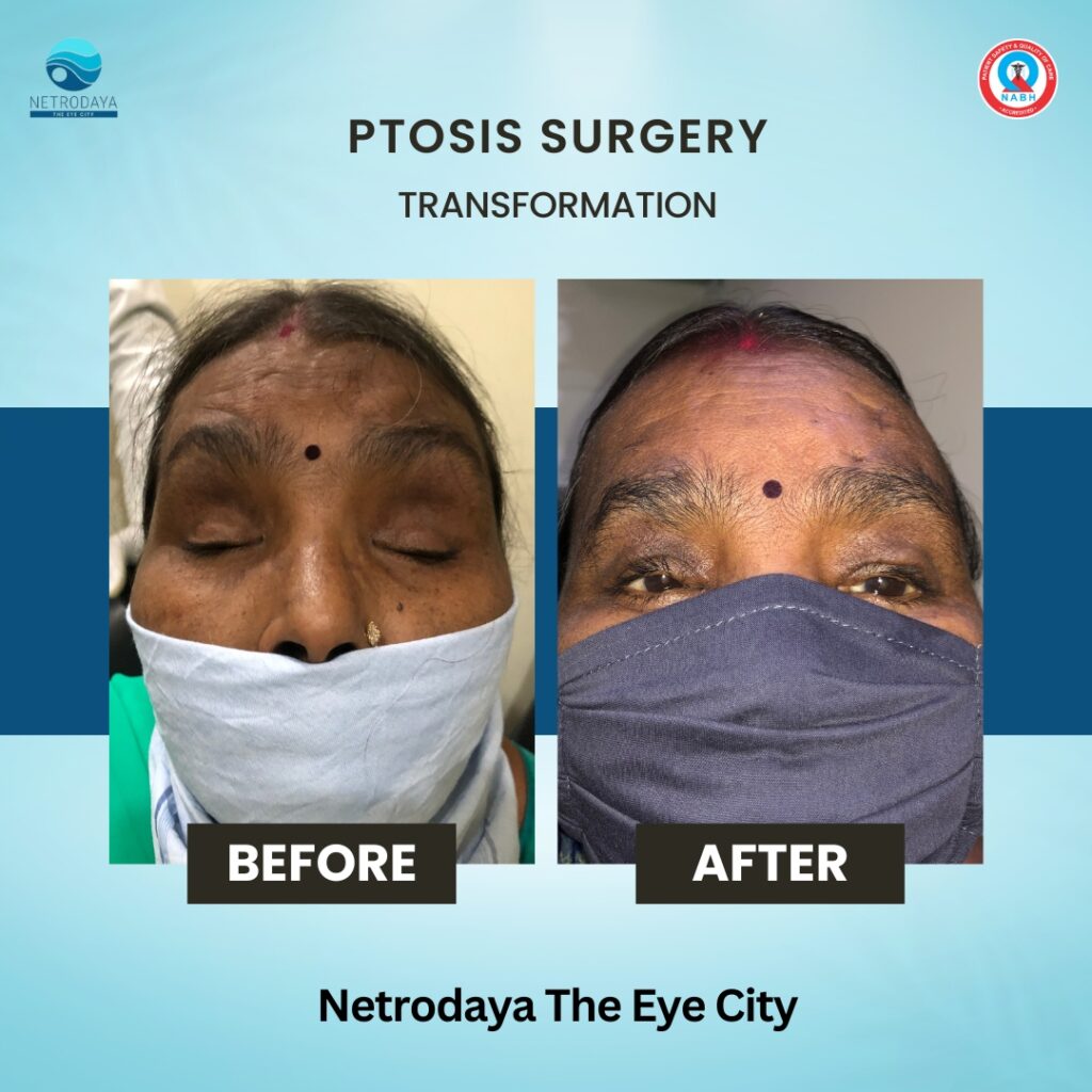 Know All About Ptosis Surgery