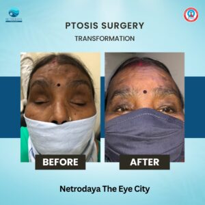 Ptosis-treatment-varanasi